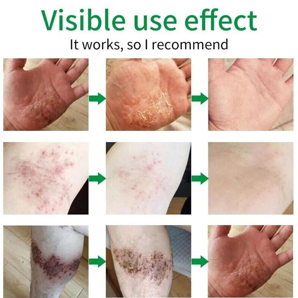 🌿 SuniFun Herbal Psoriasis & Eczema Relief Cream✨
