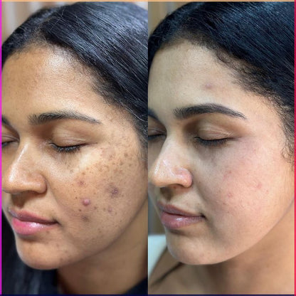 Aobenz Dark Spot Serum Remover