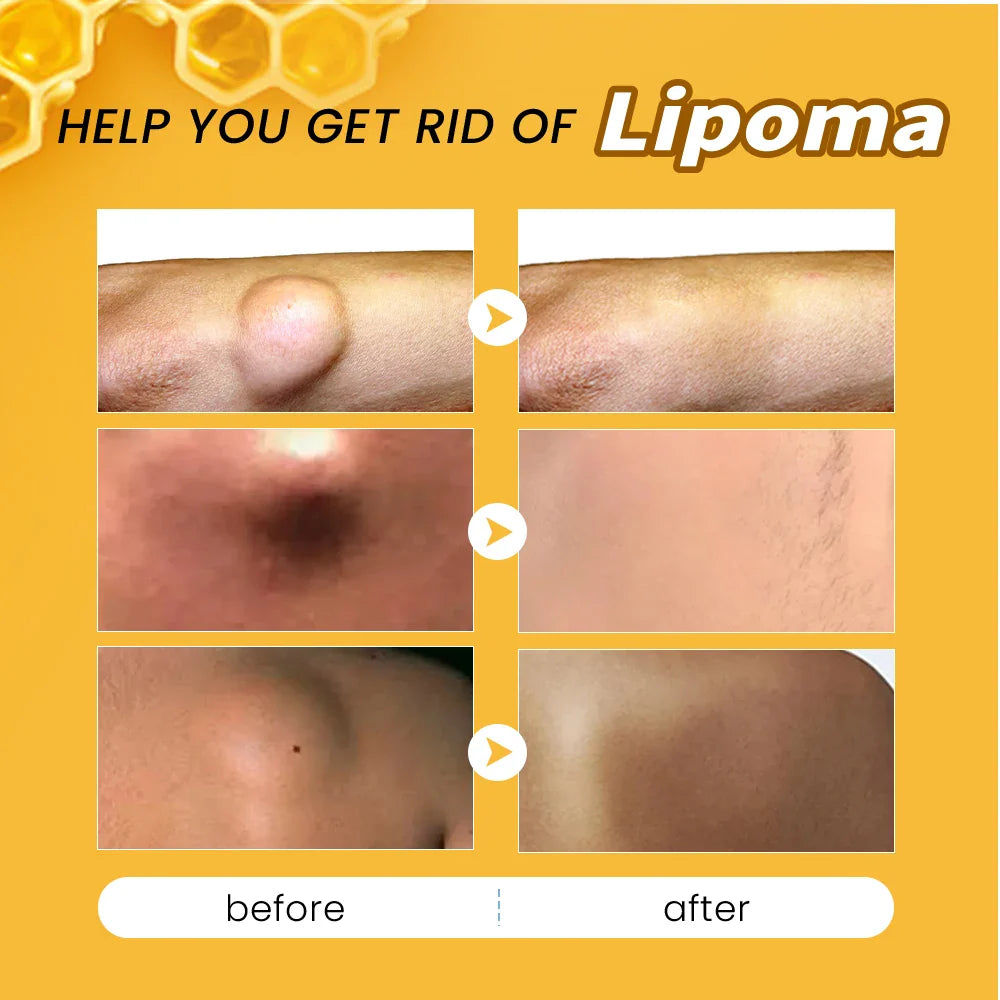 🐝✨ Sumifun Bee Venom Lipoma Cream – Transform Your Skin, Naturally! ✨🐝