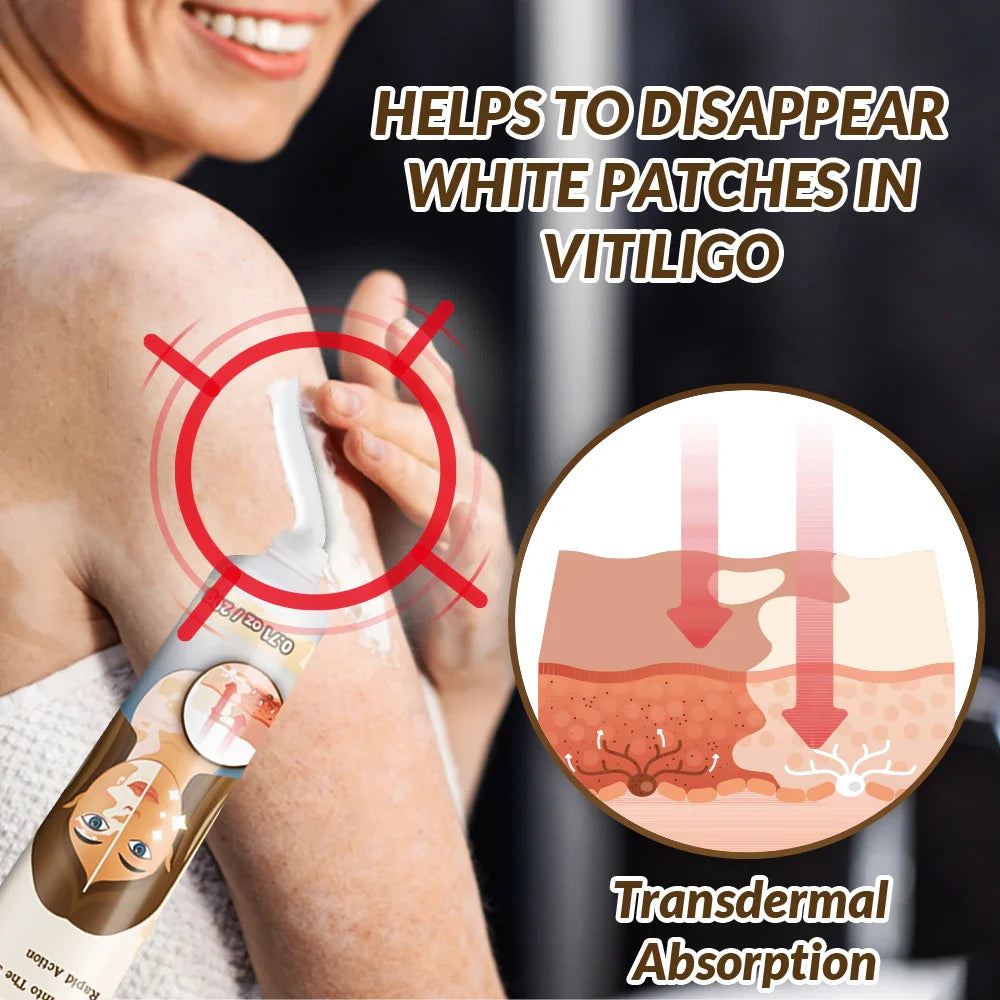 🌟 Sumifun Vitiligo Treatment Cream – Restore Your Skin’s Natural Beauty! 🌟