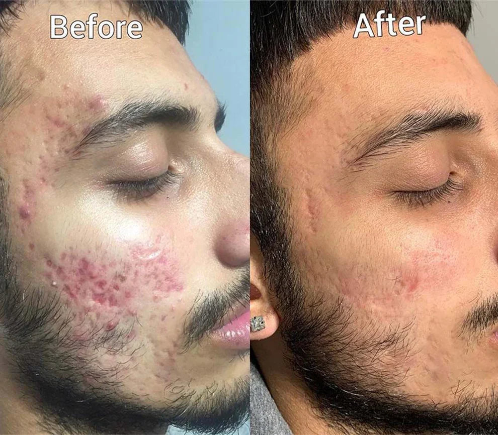 Aobenz Dark Spot Serum Remover