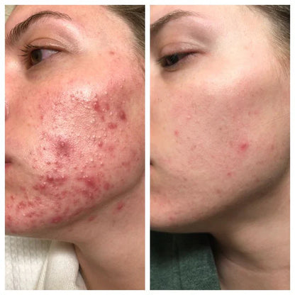 Aobenz Dark Spot Serum Remover