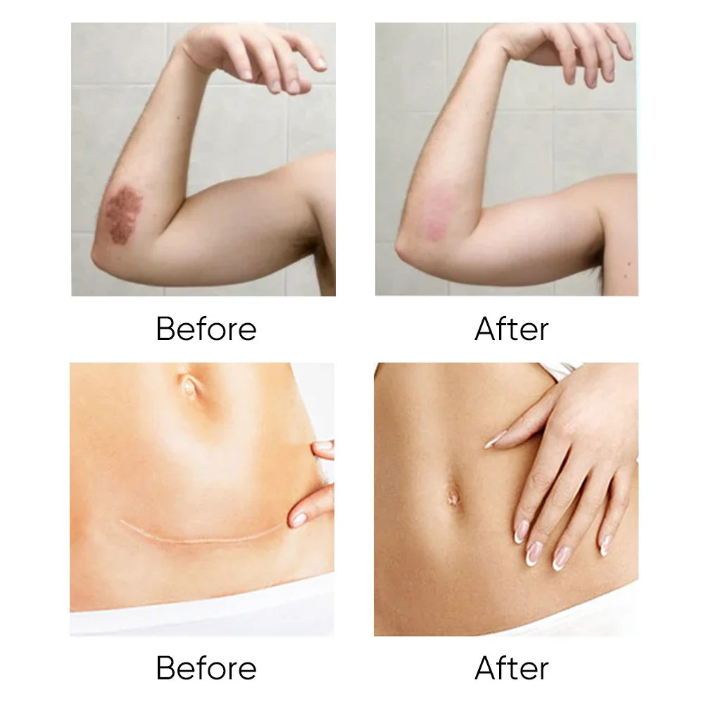 🌿 Scar Gel Body & Caesarean Section Scar Gel ✨