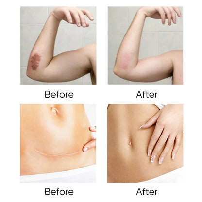 🌿 Scar Gel Body & Caesarean Section Scar Gel ✨